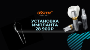 Импланты Osstem по акции 28 900 руб.