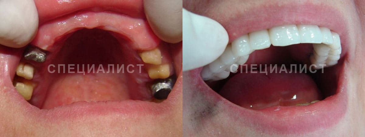 Протезирование зубов коронками из металлокерамики