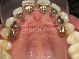 Исправление прикуса работы по ортодонтии