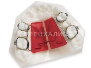Съемные ортодонтические пластины