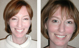 Десневая улыбка: фото до и после