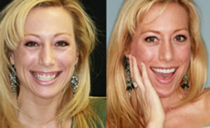 Десневая улыбка: фото до и после